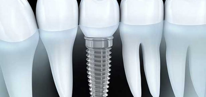 diş hekimi serkan zeybek denizli implant ortodonti estetik diş